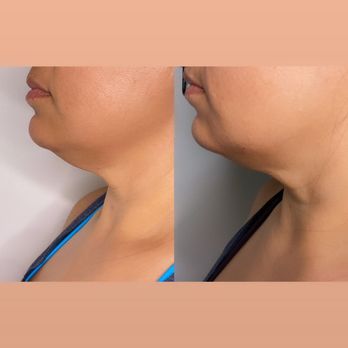 Lenué Sculpting - Non-invasive double chin removal - Body Contouring Near Me Lenué Sculpting - Non-invasive double chin removal - Body Contouring Near Me