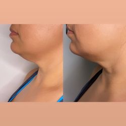 Lenué Sculpting - Non-invasive double chin removal