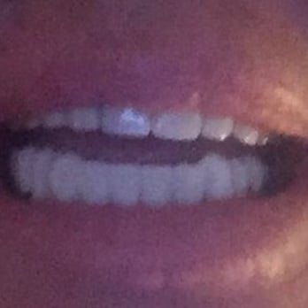 Implants Guru - Keerthi Senthil DDS, MS - Before - Oral Surgeons Near Me - Rancho Mirage, California Implants Guru - Keerthi Senthil DDS, MS - Before - Oral Surgeons Near Me - Rancho Mirage, California