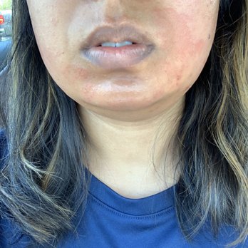 Khoobsurat Threading Salon - The salon lady burnt my face. This is what you get here. Been 3 hours and waiting to see a doctor now! Horrible service. - Hair Removal Near Me - Sunnyvale, California