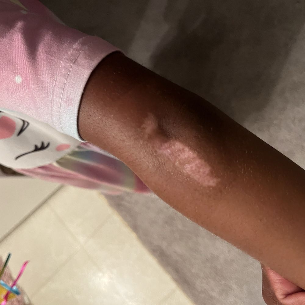 Kids Empire - Progress of my daughters painful burn from a slide at Kids Empire - Indoor Playcenter Near Me - Tampa, Florida Kids Empire - Progress of my daughters painful burn from a slide at Kids Empire - Indoor Playcenter Near Me - Tampa, Florida