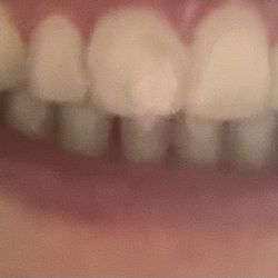 Millennium Family Dental - Dental bonding done the first time(had to return 3 times) they were uneven and bulky. And the two canines fell off after two hours..