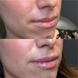 Harmony Aesthetics Center - Lip Filler