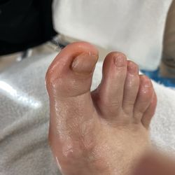 Jbella Nails - Bleeding toe from pedicure by Tina