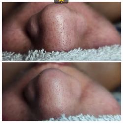 Radiant Glow Skin Studio - Extractions