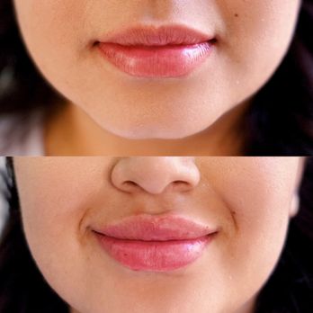 Pretty Palace - Before & After Lip Filler - Medical Spas Near Me - Las Vegas, Nevada Pretty Palace - Before & After Lip Filler - Medical Spas Near Me - Las Vegas, Nevada