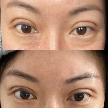 YokoMD - Day after versus four days after, still some bruising but swelling has significantly decreased. - Medical Spas Near Me - Pasadena, California YokoMD - Day after versus four days after, still some bruising but swelling has significantly decreased. - Medical Spas Near Me - Pasadena, California