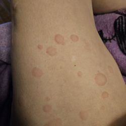 Integrative Family Wellness - Day two still having hives thanks to this so-called practitioners advice and reluctance to muscle test me to see if I was still allergic