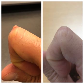 Soheil Simzar, MD - Before and 1 year after with a barely-visible scar! - Dermatologists Near Me - Santa Monica, California Soheil Simzar, MD - Before and 1 year after with a barely-visible scar! - Dermatologists Near Me - Santa Monica, California