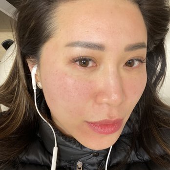 Radiance Med Spa - Right after picosure - Medical Spas Near Me - Pasadena, California Radiance Med Spa - Right after picosure - Medical Spas Near Me - Pasadena, California