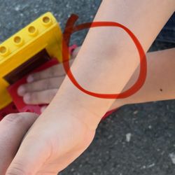 Cherryland Elementary School - Bruises on 5 yr old first day of school