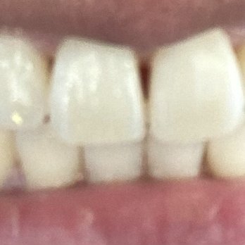 Daniel H Lee, DDS - Teeth cleaning day love the pearly white zesty clean feeling!! - General Dentistry Near Me - Placentia, California Daniel H Lee, DDS - Teeth cleaning day love the pearly white zesty clean feeling!! - General Dentistry Near Me - Placentia, California