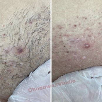 Choco Beautixx - Brazilian wax - Waxing Near Me - Brooklyn, New York