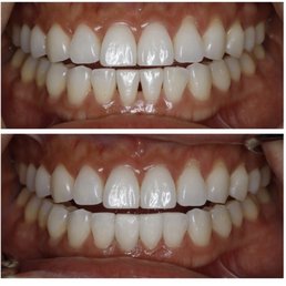 Triangle gap closure in bottom teeth