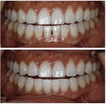 Goldberg Dental Group - Triangle gap closure in bottom teeth - Cosmetic Dentists Near Me - San Diego, California