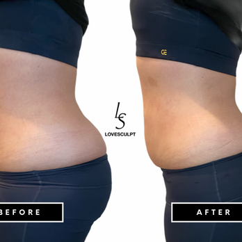 Lovesculpt - Body Contouring Near Me - Irvine, California Lovesculpt - Body Contouring Near Me - Irvine, California