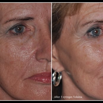 David de Jongh, DDS - Let Dr. de Jongh help you cure the disease of aging with Voluma to restore the proper contours and lost volume of your face. - Medical Spas Near Me - Houston, Texas David de Jongh, DDS - Let Dr. de Jongh help you cure the disease of aging with Voluma to restore the proper contours and lost volume of your face. - Medical Spas Near Me - Houston, Texas