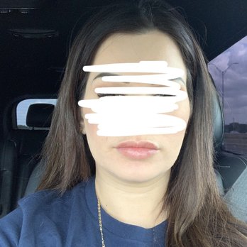 Ideal Image North Austin - Lip fillers after - Laser Hair Removal Near Me - Austin, Texas