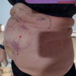Park Avenue - Same day after surgery