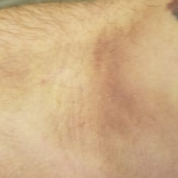 Biomat USA - Black and blue after donating, twice in two months. - Blood & Plasma Donation Centers Near Me - Dickson City, Pennsylvania Biomat USA - Black and blue after donating, twice in two months. - Blood & Plasma Donation Centers Near Me - Dickson City, Pennsylvania