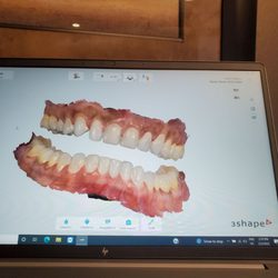 Midwest Dental Sleep Center - My teeth are ready for the alignment device.