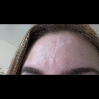 Dr Guy Facial Plastic Surgery - After he ruined my face with CO2 laser - Plastic Surgeons Near Me - Conroe, Texas