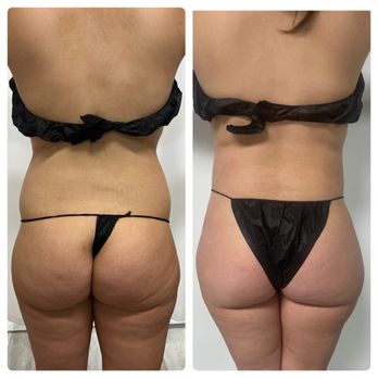 AirSculpt - Charlotte - Cosmetic Surgeons Near Me - Charlotte, North Carolina AirSculpt - Charlotte - Cosmetic Surgeons Near Me - Charlotte, North Carolina