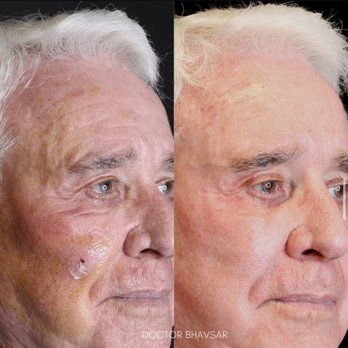 Brea Wellness Center - He had an Accutite Procedure along with some fat transfer it looks amazing! - Laser Hair Removal Near Me - Fullerton, California Brea Wellness Center - He had an Accutite Procedure along with some fat transfer it looks amazing! - Laser Hair Removal Near Me - Fullerton, California