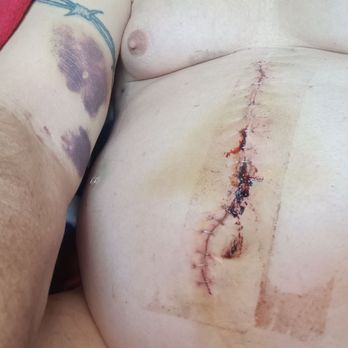 Riverside Community Hospital - Abdominal Incision. - Hospitals Near Me - Riverside, California Riverside Community Hospital - Abdominal Incision. - Hospitals Near Me - Riverside, California