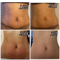 Sculpted Beauties - Ultrasonic cavitation and radio frequency results.