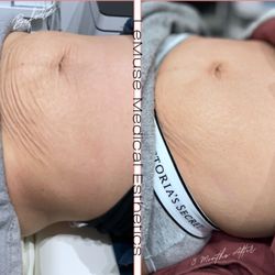 LeMuse Medical Esthetics - Hyperdilute Radiesse Abdomen Tightening