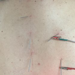 Holistic Acupuncture - Greensboro