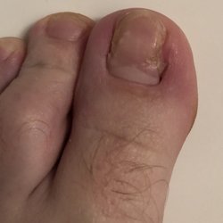 Foot Specialists of Mississippi - After going to Dr. Vanyperen for ingrown toenail extraction my toenail is really messed up.