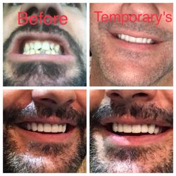 Long Beach Total Dental Care - Before, Temp teeth, and After's