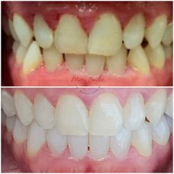 Metro Smiles, PC - Invisalign magic!