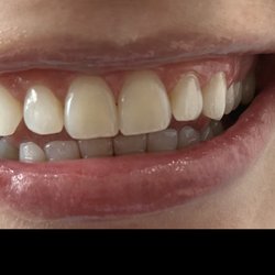 SunRisa Teeth Whitening