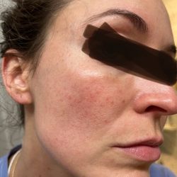 UPDATE: After second round of IPL, day-of treatment