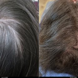 Advanced Facial Plastic Surgery Center - PRP Hair Restoration