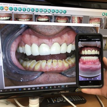 Brian Homann - Before and After - General Dentistry Near Me - Elk Grove Village, Illinois Brian Homann - Before and After - General Dentistry Near Me - Elk Grove Village, Illinois