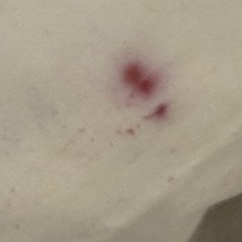 Fred's Inn Restaurant & Lodging - Blood an example of bed bug bites - Hotels Near Me - Norwich, New York Fred's Inn Restaurant & Lodging - Blood an example of bed bug bites - Hotels Near Me - Norwich, New York