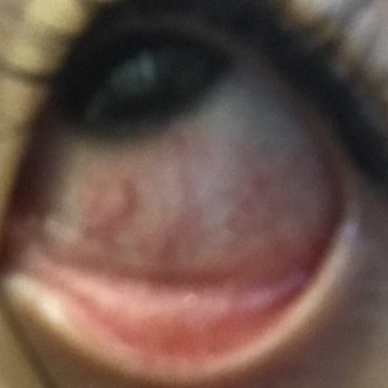 I Love Lash - Day 3 post eyelash extensions - chemical burning after effect - Eyelash Service Near Me - Fort Lee, New Jersey I Love Lash - Day 3 post eyelash extensions - chemical burning after effect - Eyelash Service Near Me - Fort Lee, New Jersey