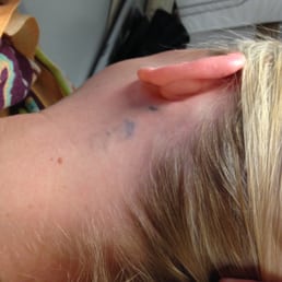 After 6 or 7 treatments. These were 3 NEON stars. Still fades more and more as time goes by. After 6 or 7 treatments. These were 3 NEON stars. Still fades more and more as time goes by.
