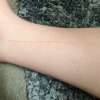 LV Nail Spa - Long cut from ankle up the side of my calf. - Nail Salons Near Me - Fort Collins, Colorado LV Nail Spa - Long cut from ankle up the side of my calf. - Nail Salons Near Me - Fort Collins, Colorado