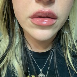 REFINE Medical Spa - Immediately after 1ml versa