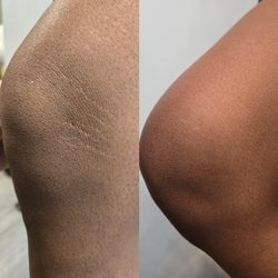 Stretchmark treatment-we specialize in all skin types and tones.