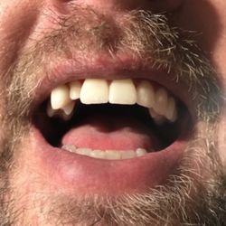 3 days after his procedure. 5 teeth fell out the first week! I had to use fixident to make them stay in.