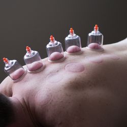Healix Wellness - Cupping