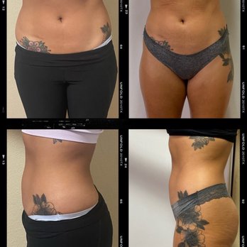 Belleza Vibes - Results from 6 Sessions of Hip fat Reduction. - Body Contouring Near Me Belleza Vibes - Results from 6 Sessions of Hip fat Reduction. - Body Contouring Near Me