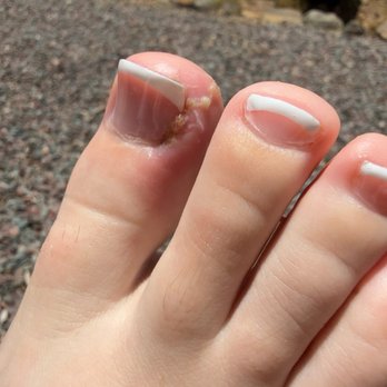Kathy Nails & Spa - Infected toe and toe nail - Nail Salons Near Me - Prescott Valley, Arizona Kathy Nails & Spa - Infected toe and toe nail - Nail Salons Near Me - Prescott Valley, Arizona