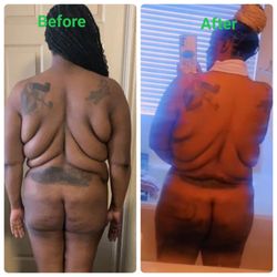 Vixen Plastic Surgery - This is a before and after. My back looks pretty much identical.